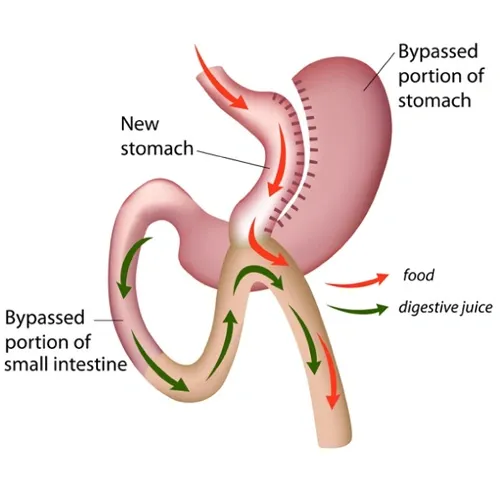 Mini Gastric Bypass or one anastomosis Gastric Bypass (OAGB)